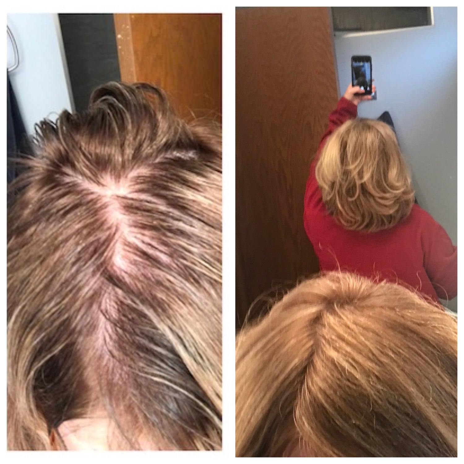 Covid hair loss, Covid hair loss treatment, adaptogenic mushrooms, hair serum, before and after pictures